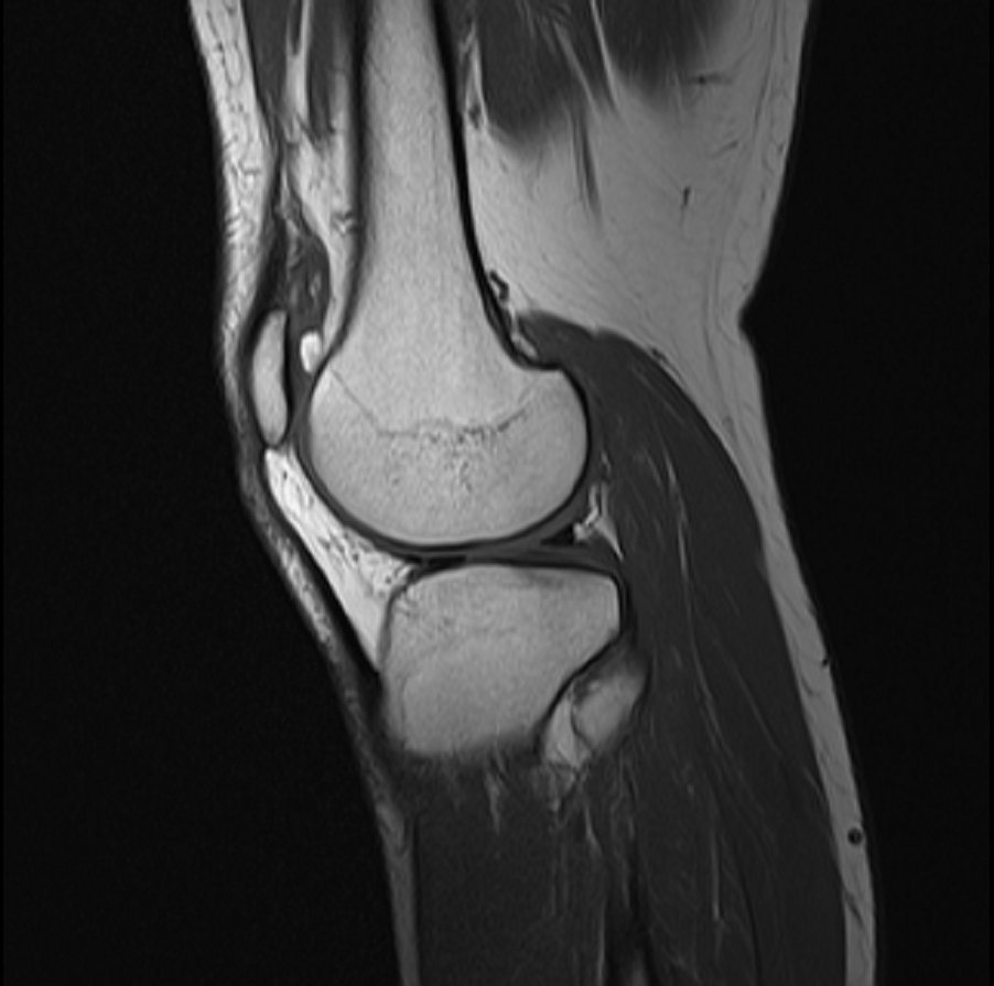 Knee MRI, sagittal view