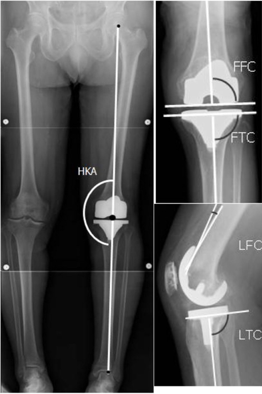 Long-leg X-ray of lower limb alignment